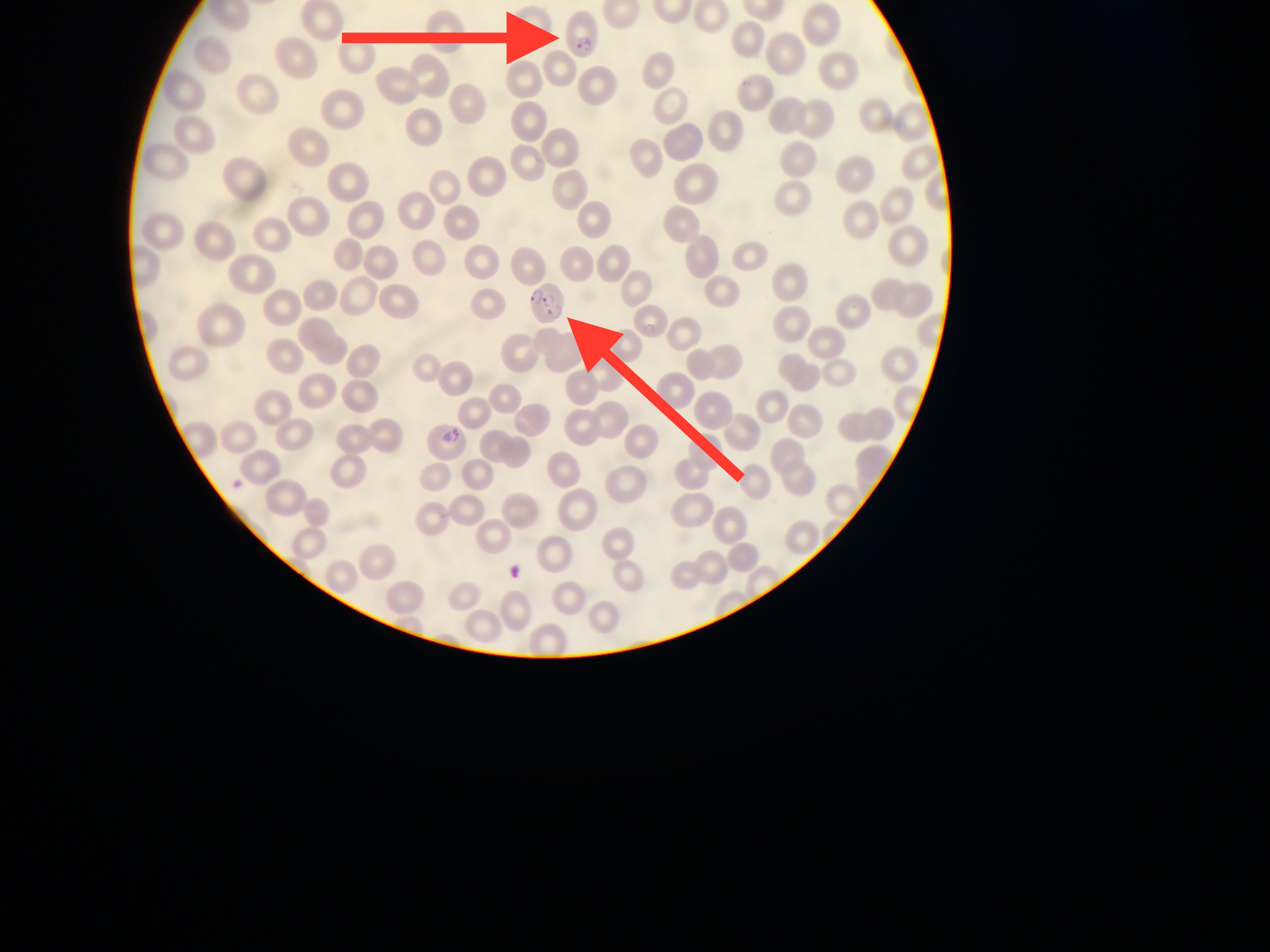 Globuli rossi fotografati da iPhone via microscopio